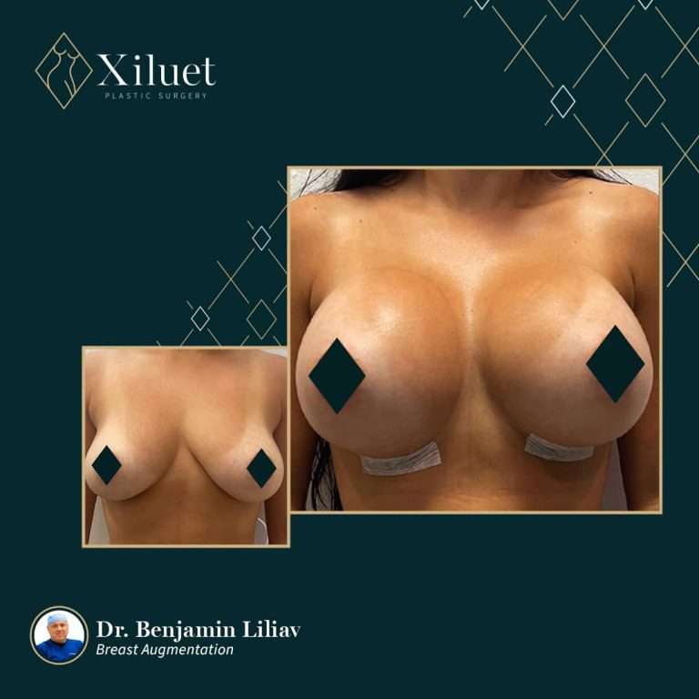 breast augmentation