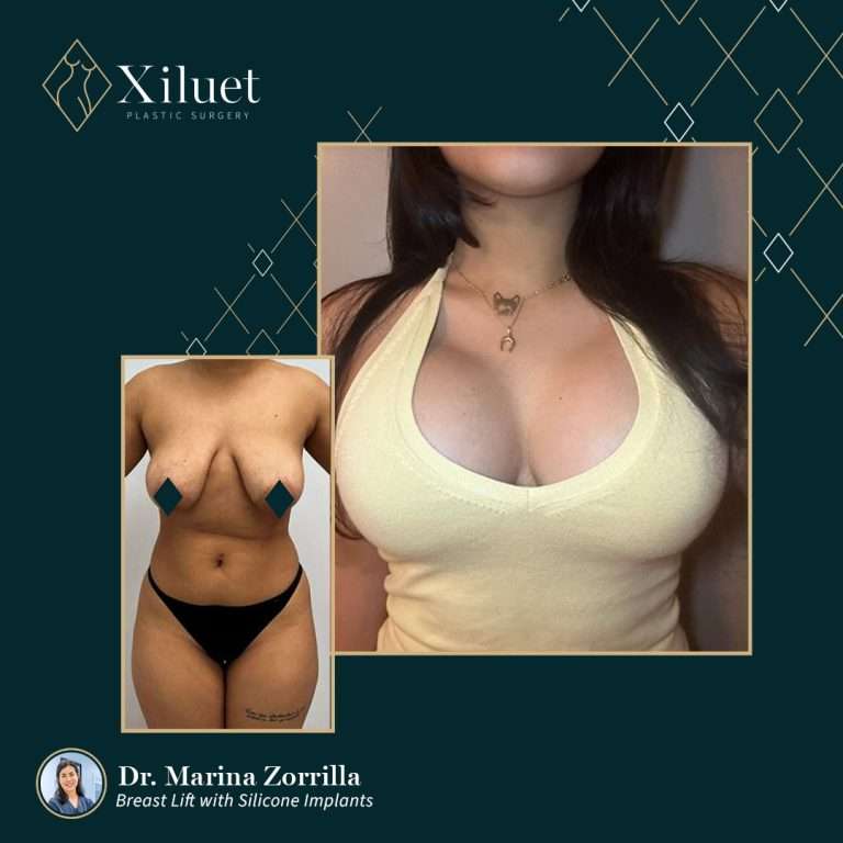 breast lift