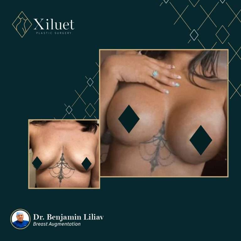 breast lift silicone