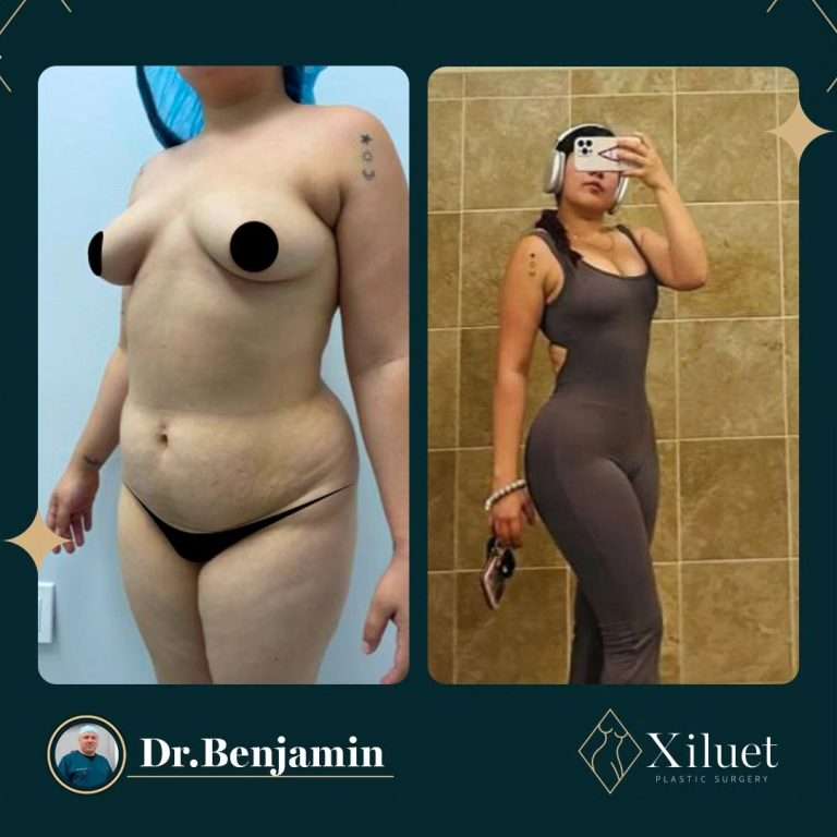 lipo tummy tuck breast lift